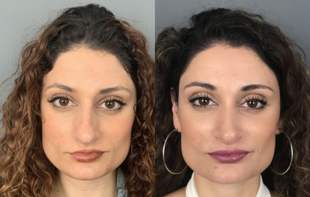 Rinoplastia feminino natural Lisboa