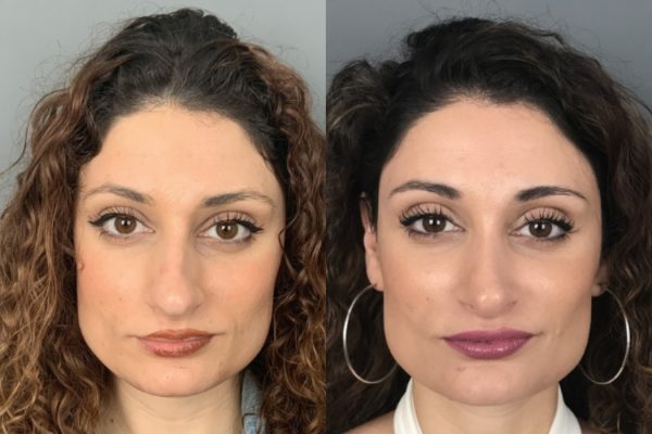 Rinoplastia feminino natural Lisboa