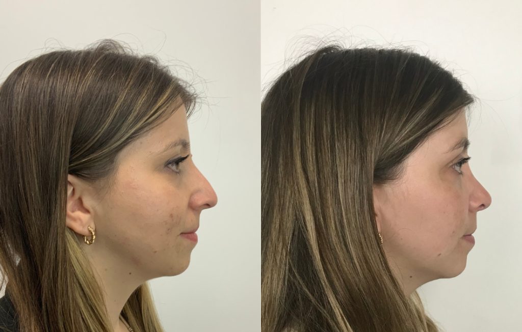 Rinoplastia mulher funcional e estética Porto