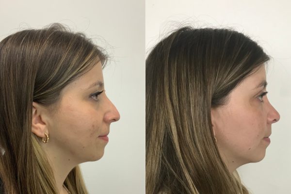 Rinoplastia mulher funcional e estética Porto