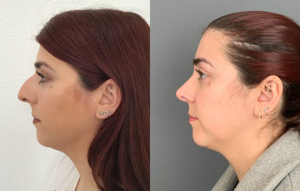 Rinoplastia cirurgia Lisboa estética lado natural
