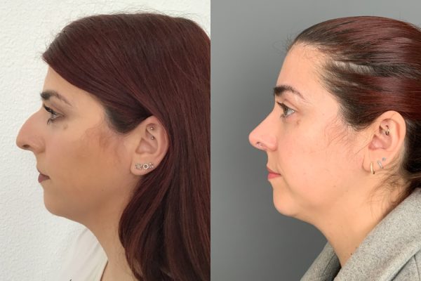 Rinoplastia cirurgia Lisboa estética lado natural