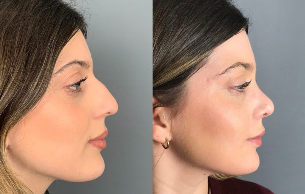 Rinoplastia mulher Lisboa