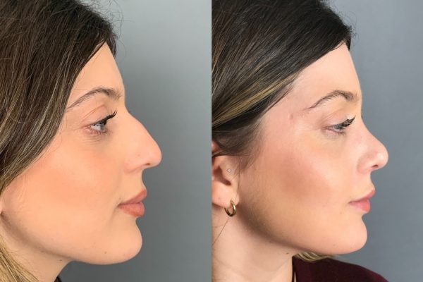 Rinoplastia mulher Lisboa