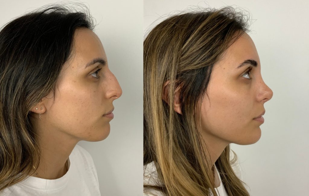 Rinoplastia antes e depois perfil feminino Porto