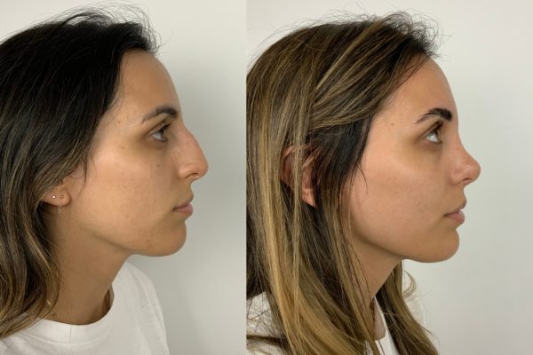 Rinoplastia antes e depois perfil feminino Porto