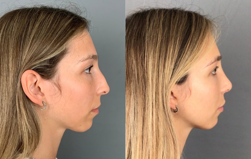 Rinoplastia mulher funcional e estética Lisboa
