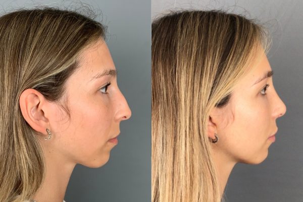 Rinoplastia mulher funcional e estética Lisboa