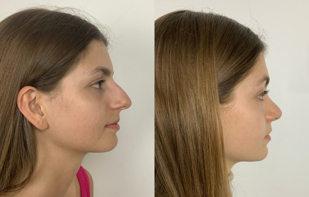 Rinoplastia cirurgia Porto estética lado natural