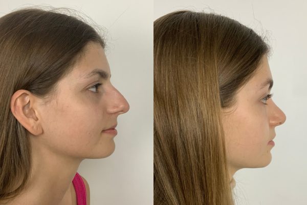 Rinoplastia cirurgia Porto estética lado natural