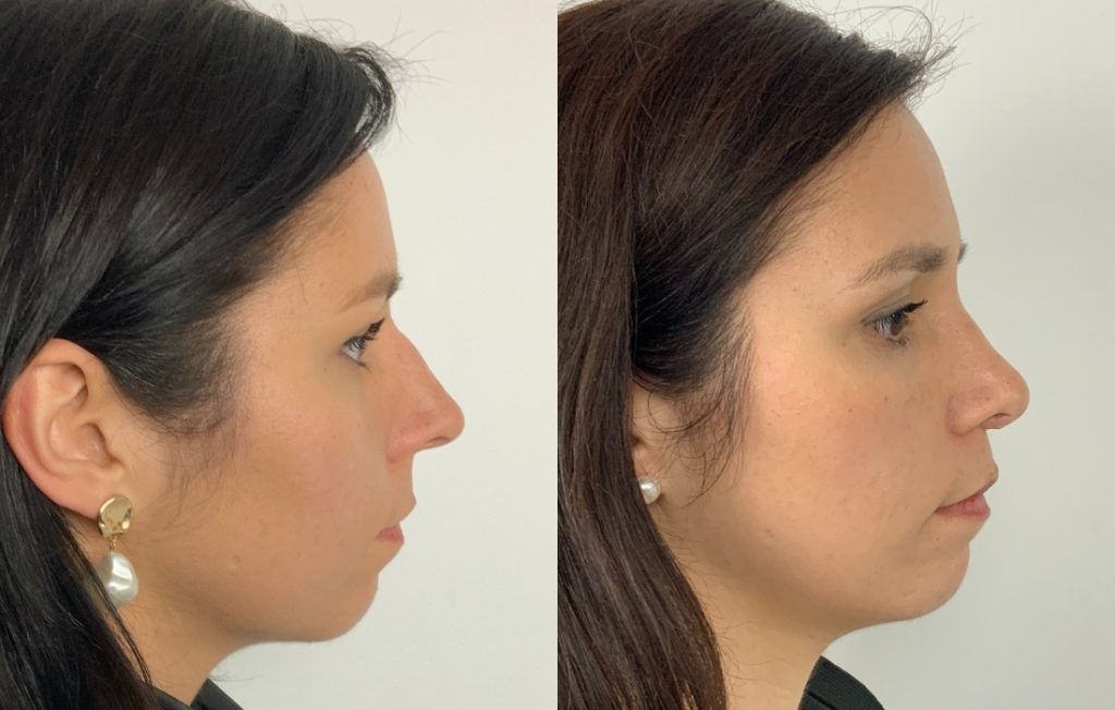 Rinoplastia mulher Porto