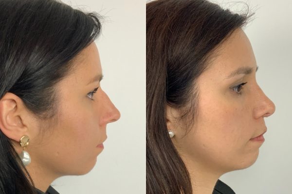 Rinoplastia mulher Porto