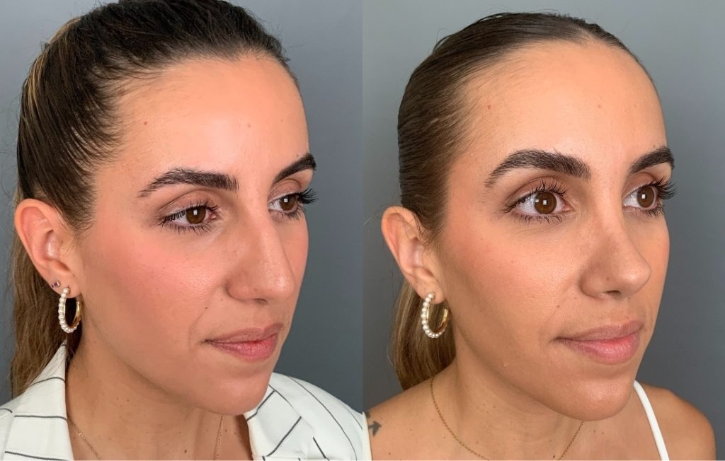 Rinoplastia de frente Lisboa cirurgia estética