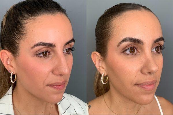 Rinoplastia de frente Lisboa cirurgia estética