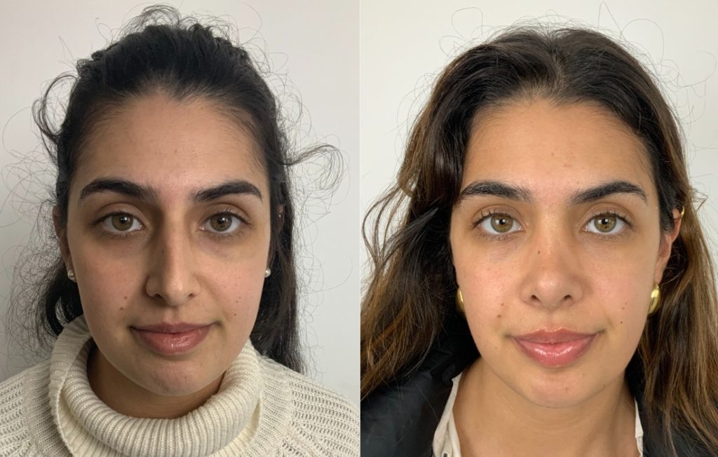 Rinoplastia mulher frontal Lisboa