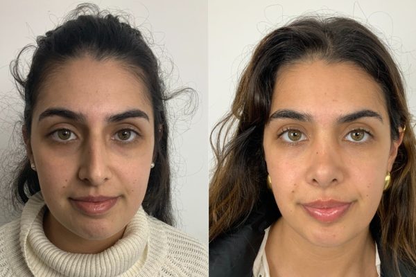 Rinoplastia mulher frontal Lisboa