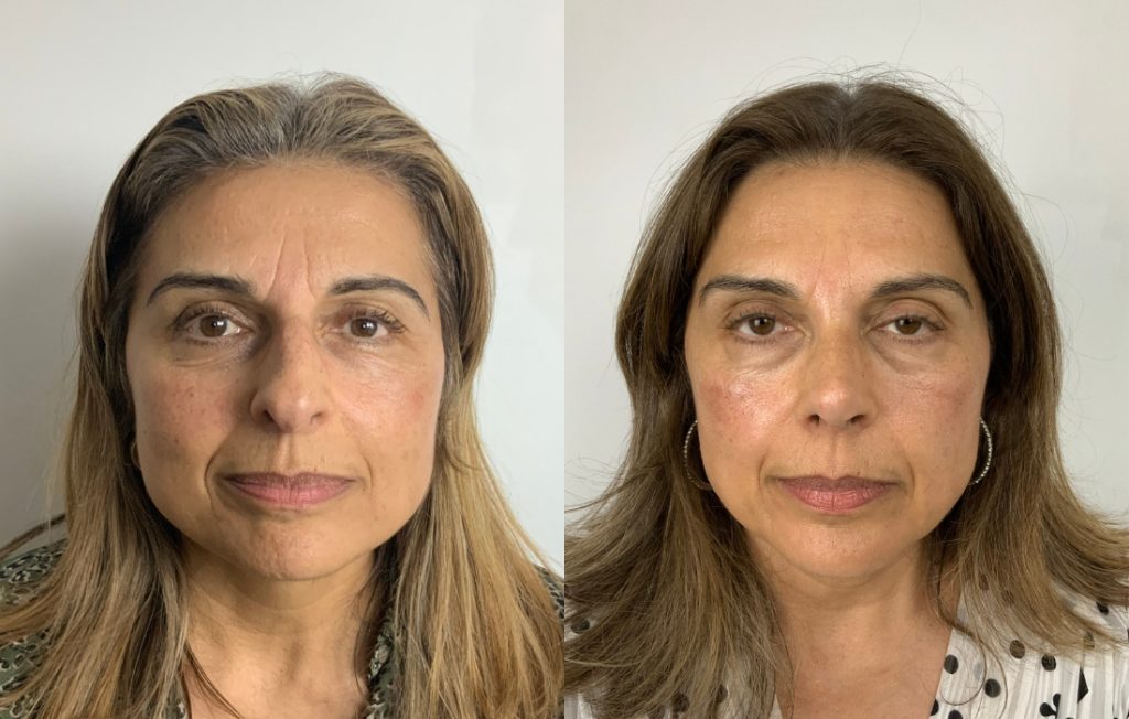 Cirurgia do nariz antes e depois vista frontal feminina