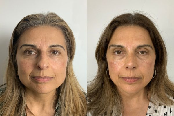 Cirurgia do nariz antes e depois vista frontal feminina