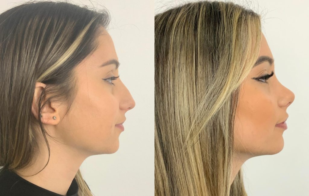 Rinoplastia caso feminino de lado cirurgia estética