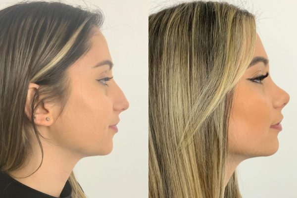 Rinoplastia caso feminino de lado cirurgia estética