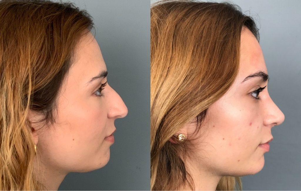 Rinoplastia Lisboa cirurgia estética