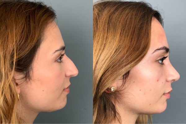 Rinoplastia Lisboa cirurgia estética