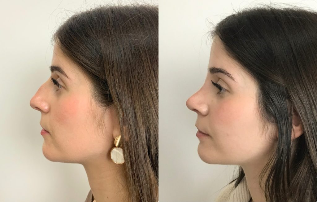 Rinosseptoplastia feminino lado Lisboa natural