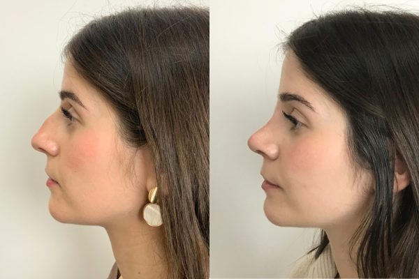 Rinosseptoplastia feminino lado Lisboa natural