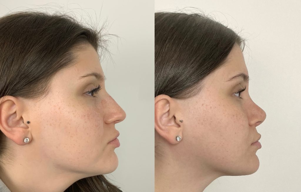 Resultado de rinoplastia estruturada vista lateral Lisboa