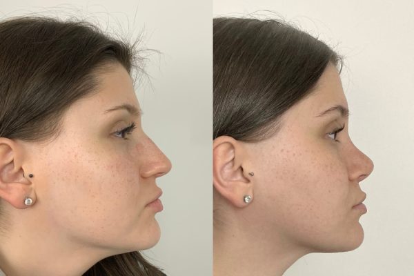 Resultado de rinoplastia estruturada vista lateral Lisboa