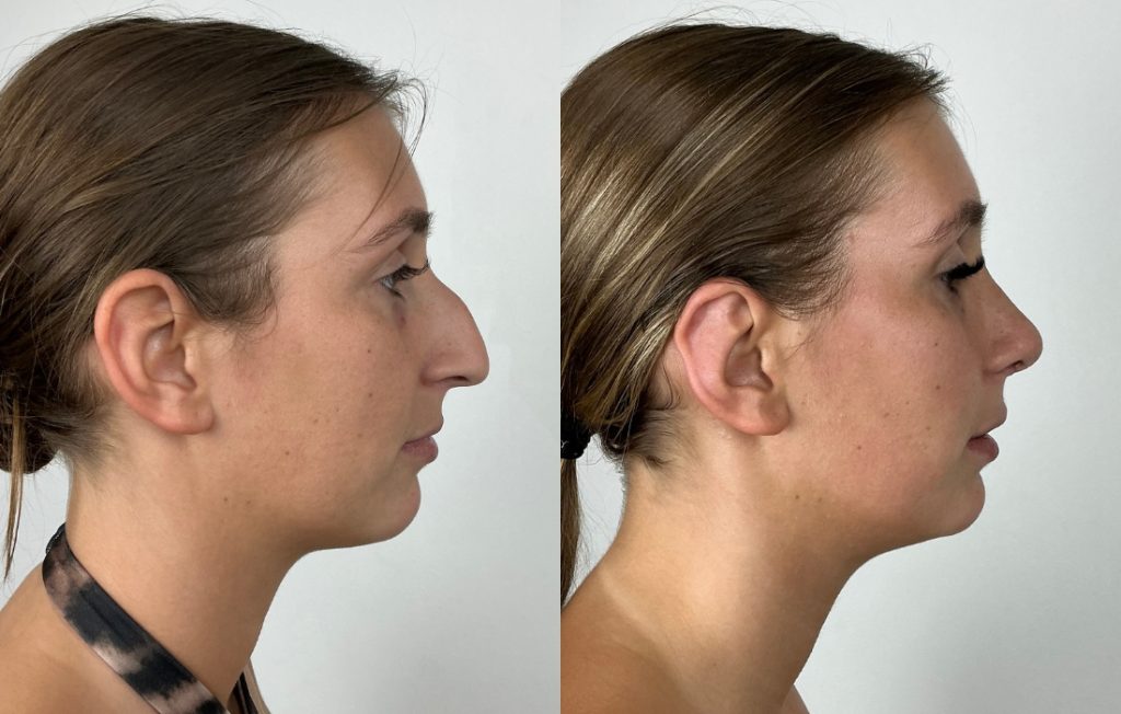 Resultado de rinoplastia estruturada vista lateral Porto
