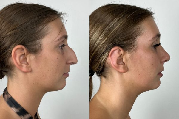 Resultado de rinoplastia estruturada vista lateral Porto