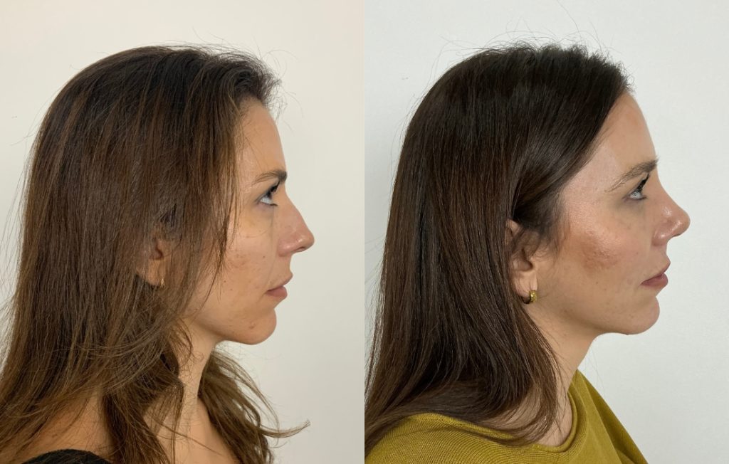 Rinoplastia antes e depois paciente feminina perfil natural