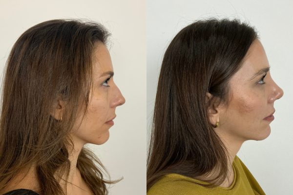 Rinoplastia antes e depois paciente feminina perfil natural