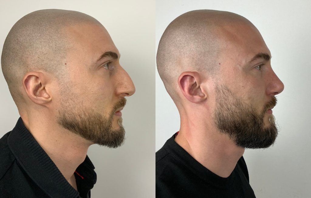 Rinoplastia masculina resultado natural perfil