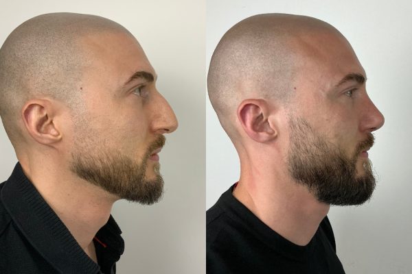 Rinoplastia masculina resultado natural perfil