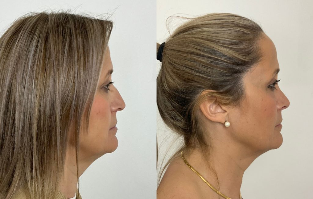 Cirurgia ao nariz com resultado harmonioso antes e depois