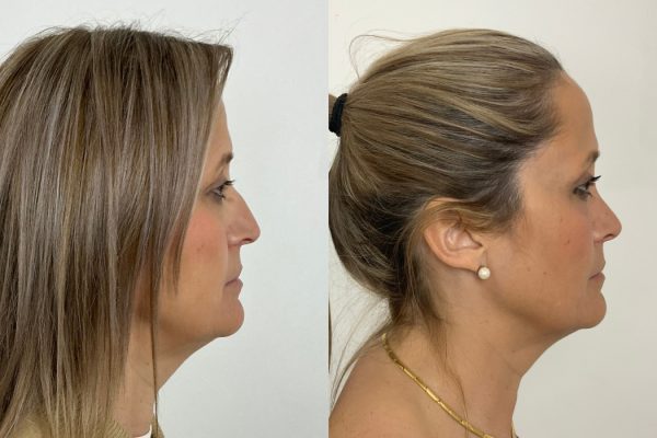 Cirurgia ao nariz com resultado harmonioso antes e depois