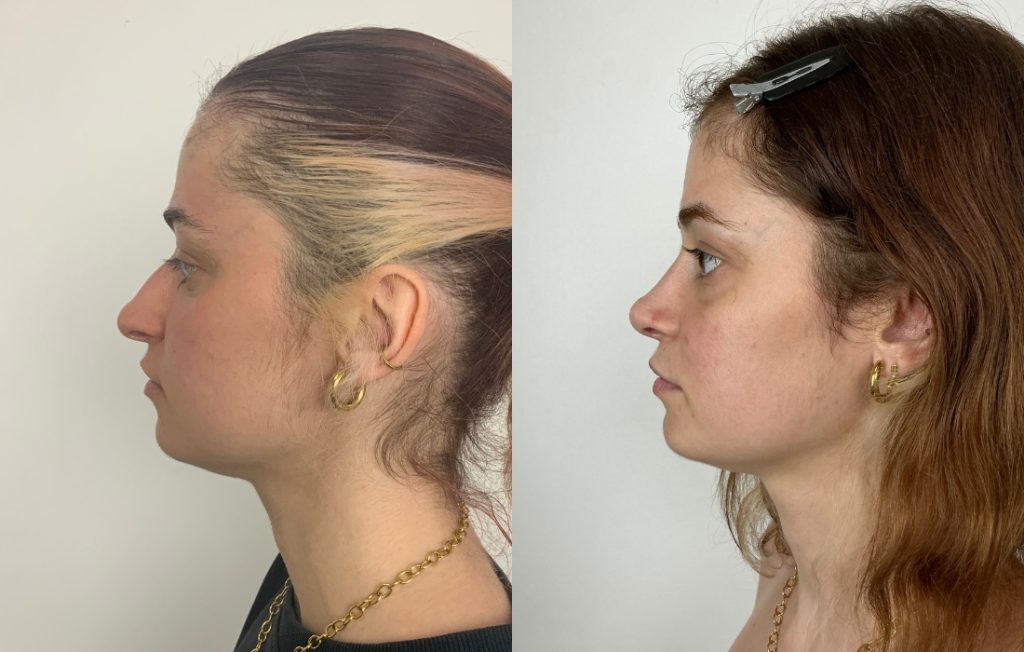 Rinoplastia com melhoria estética do nariz antes e depois Lisboa