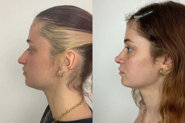 Rinoplastia com melhoria estética do nariz antes e depois Lisboa
