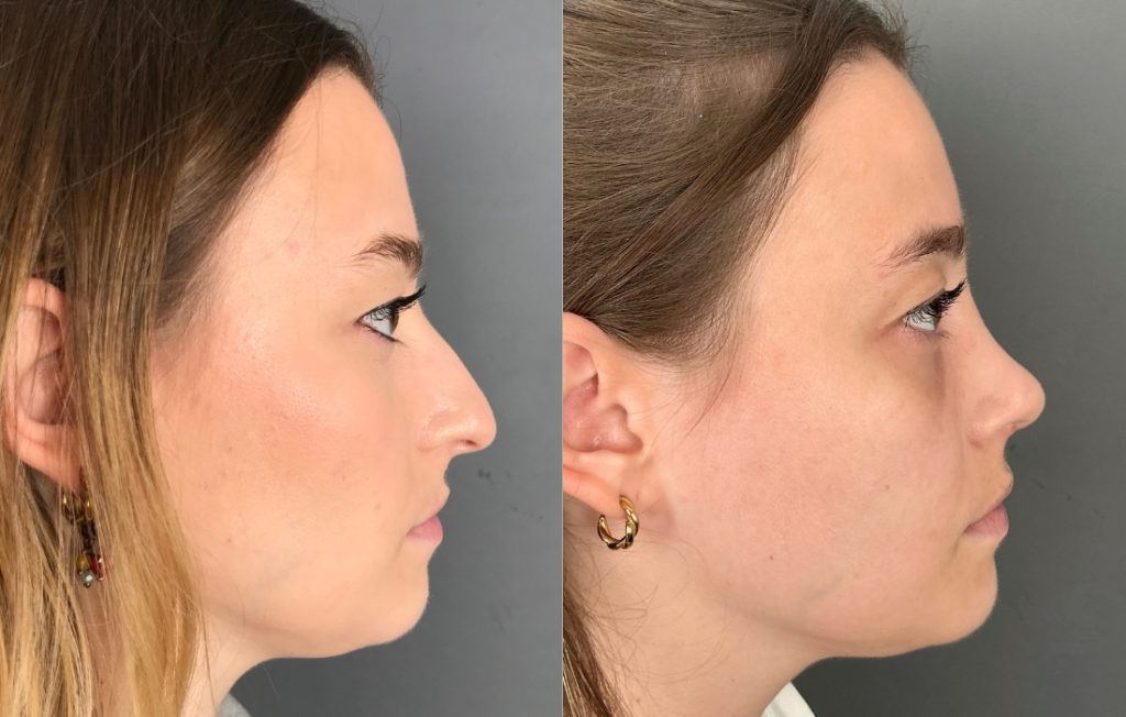 Rinoplastia com melhoria estética do nariz antes e depois Porto