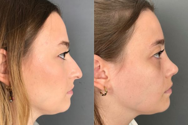 Rinoplastia com melhoria estética do nariz antes e depois Porto