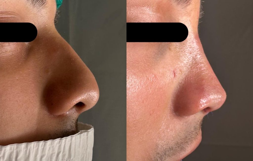 Rinoplastia masculina resultado natural perfil Porto