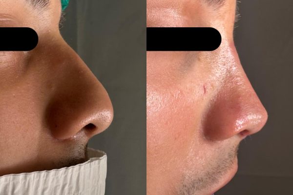 Rinoplastia masculina resultado natural perfil Porto