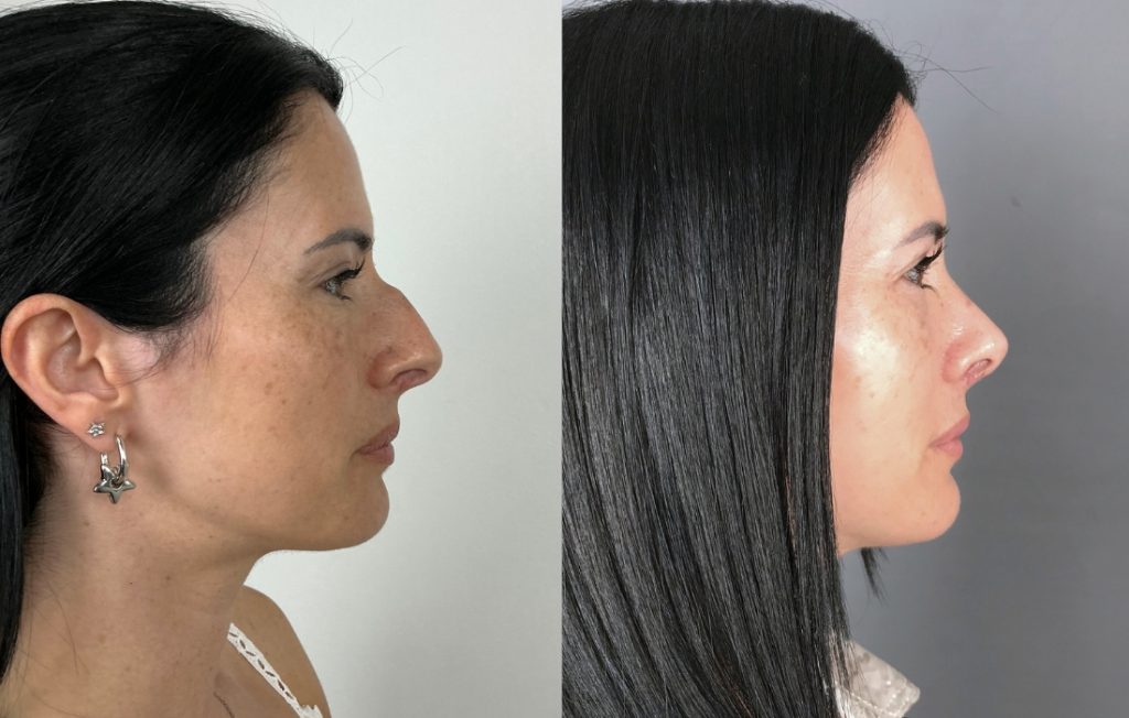 Rinoplastia feminina resultado natural vista lateral Lisboa