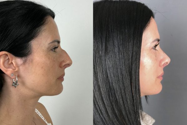 Rinoplastia feminina resultado natural vista lateral Lisboa
