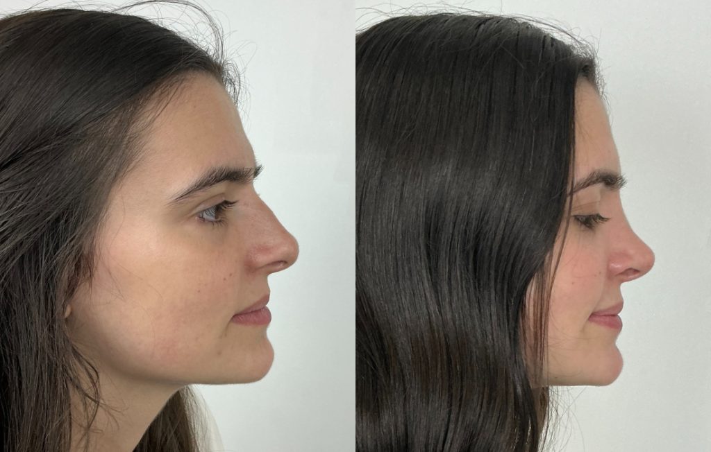 Rinoplastia feminina resultado natural vista lateral Lisboa