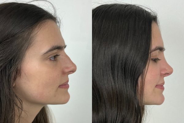 Rinoplastia feminina resultado natural vista lateral Lisboa