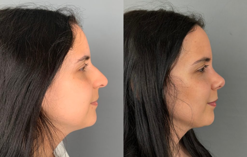 Rinosseptoplastia feminino de lado natural Porto