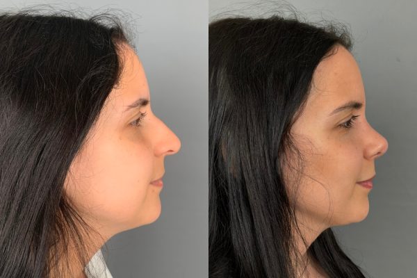 Rinosseptoplastia feminino de lado natural Porto